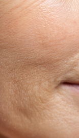 깊어진 미세주름