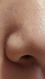 묵은 피지/각질